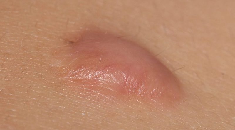 Góc giải đáp: Sản phẩm Hiruscar có trị sẹo lồi không? 1