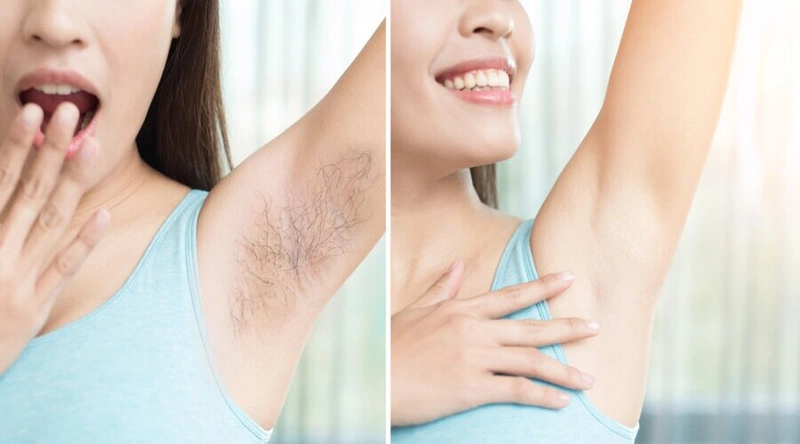 Vùng lông nách có thể gây mùi hôi, viêm da vùng nách vì vậy bạn nên triệt lông nách triệt để