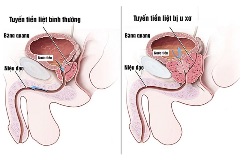 Tư vấn: U xơ tiền liệt tuyến nên ăn gì và kiêng ăn gì 1