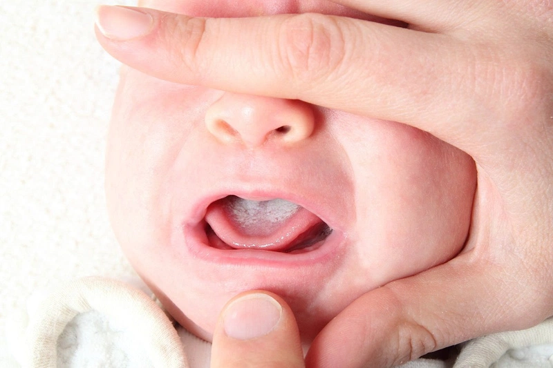 Tưa lưỡi ở trẻ sơ sinh là gì