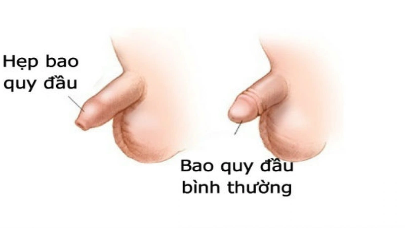Tuột bao quy đầu bị sưng phồng nguyên nhân do đâu