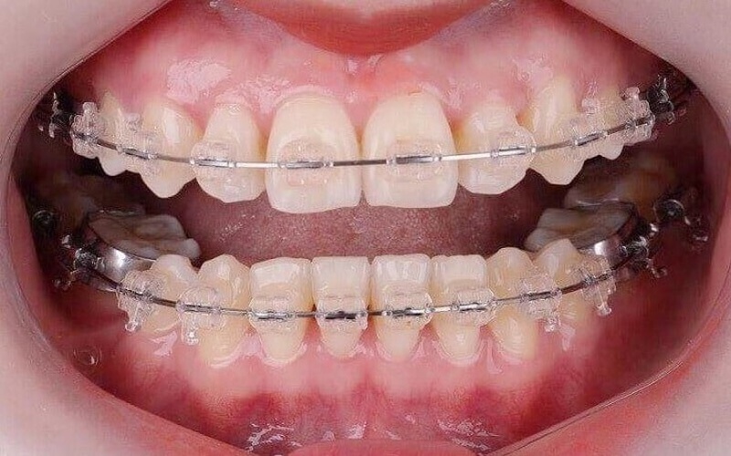 Niềng răng có thể điều trị được các tình trạng tụt lợi chân răng