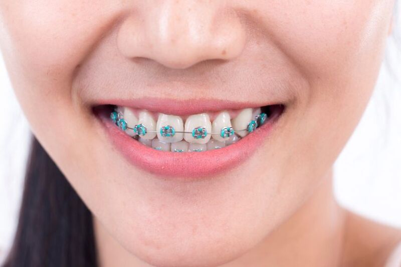 Một số lưu ý cho tình trạng tụt lợi nhưng muốn niềng răng