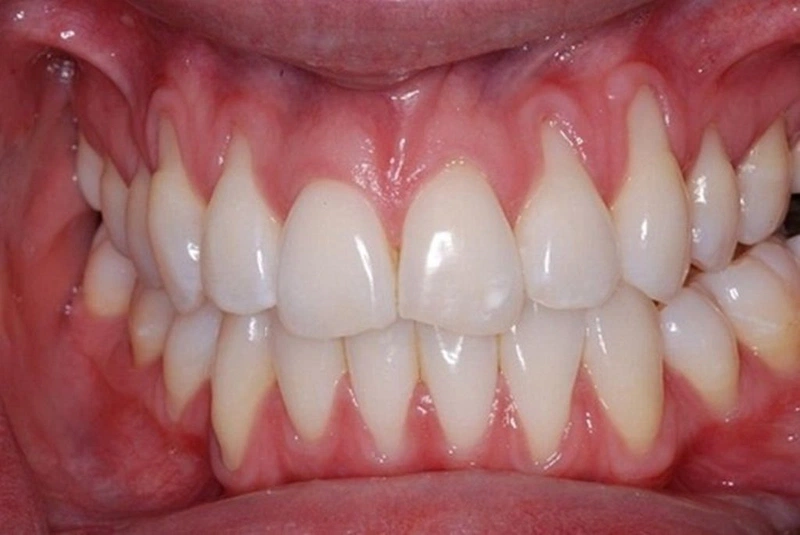 Tụt lợi có tự khỏi không? Cách đối phó khi bị tụt lợi? 1