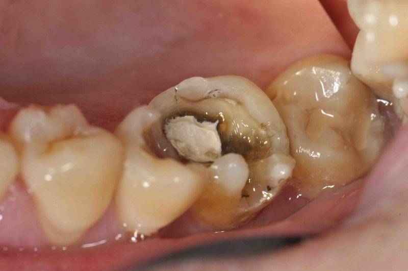 Tủy răng bị hoại tử có nguy hiểm không? Điều trị hoại tử tủy răng như thế nào? 1