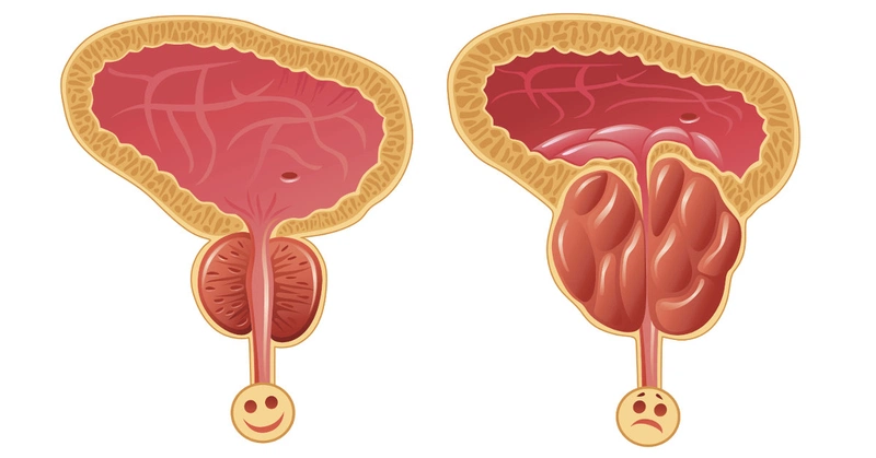 Tuyến tiền liệt nằm ở đâu? Biểu hiện nào cần đi bác sĩ?