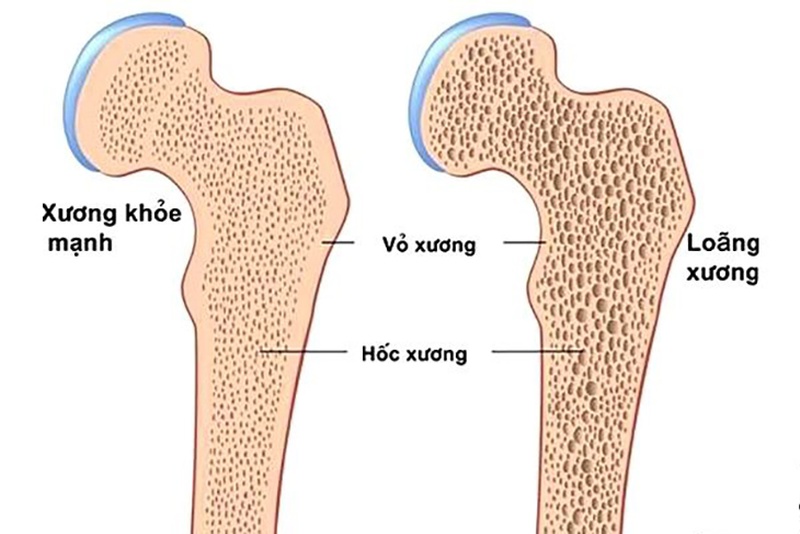 Tỷ lệ loãng xương ở Việt Nam ngày càng tăng: Nguyên nhân, cách phòng ngừa hiệu quả 1