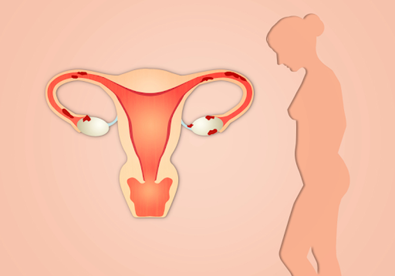 Những thông tin cần biết về u lạc nội mạc tử cung tái phát
