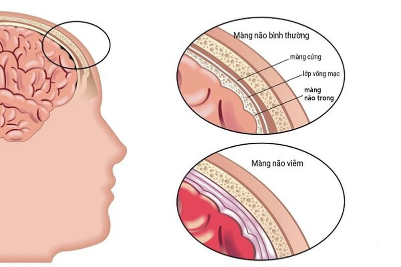 U màng não thất ở trẻ em là bệnh gì? 1