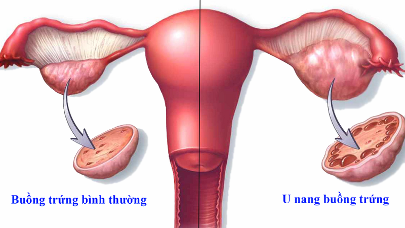 U nang buồng trứng là gì?