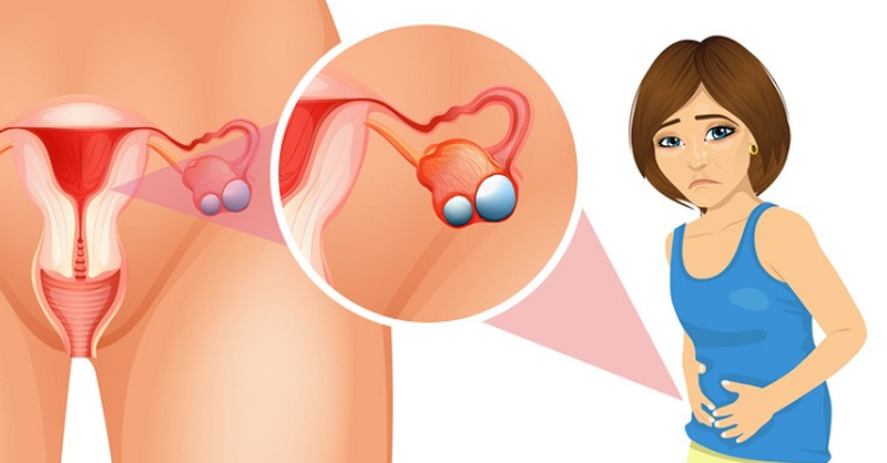 Giải đáp: U nang buồng trứng phải có thai được không? 2