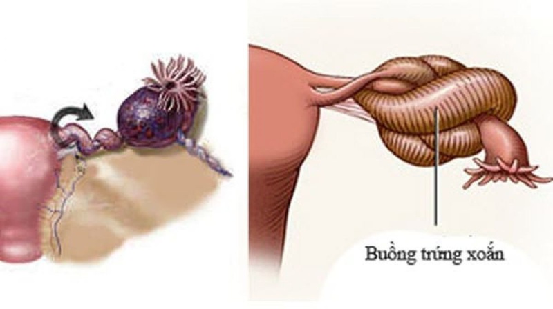 Giải đáp: U nang buồng trứng phải có thai được không? 5