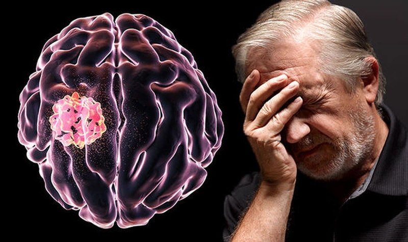 Đau đầu là triệu chứng thường gặp của u não ác tính