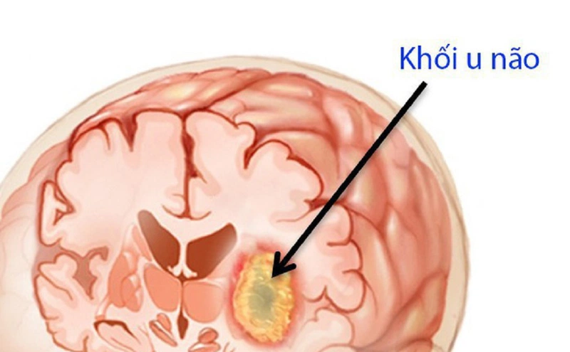 U não di căn là gì? Biểu hiện của bệnh