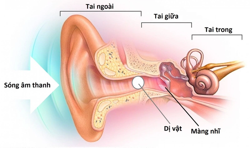 Ù tai chảy máu tai: Dấu hiệu nguy hiểm 2