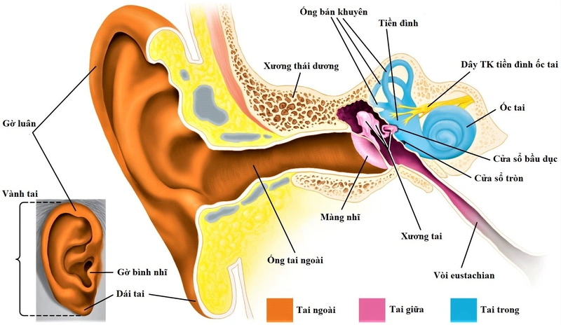 Ù tai dây thần kinh thính giác là bệnh gì? 1