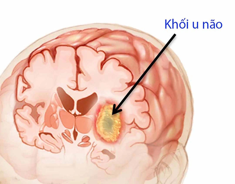 Ù tai kéo dài gặp ở bệnh gì và có nguy hiểm không 3