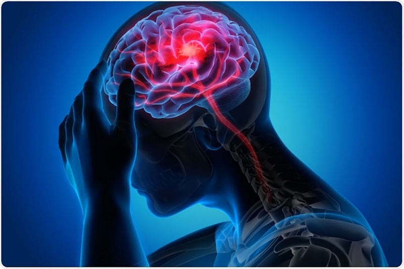 Ù tai nhức đầu: Nguyên nhân và cách điều trị 2