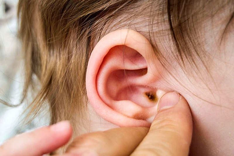 Ù tai sau khi ngoáy tai không đúng cách 4