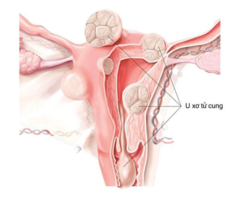 U xơ tử cung có nguy hiểm không? 1