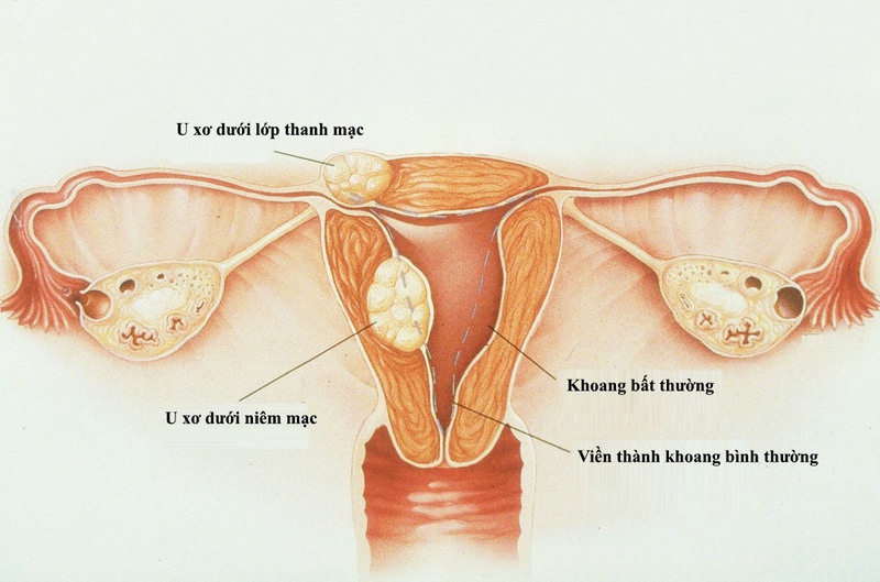 U xơ tử cung khi mang thai phải làm gì? 1