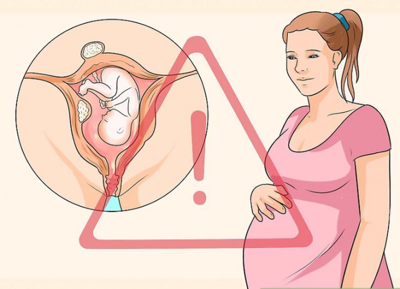 U xơ tử cung khi mang thai phải làm gì? 2