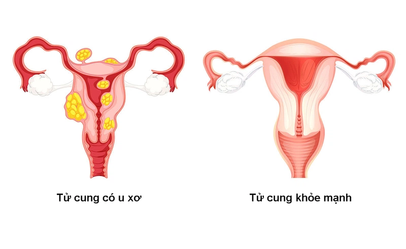 U xơ tử cung lành tính có tự teo được không và điều trị như thế nào? 1