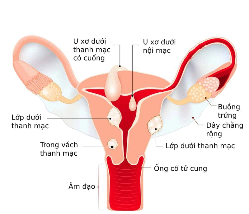Sự tác động giữa u xơ tử cung và thai nghén 1