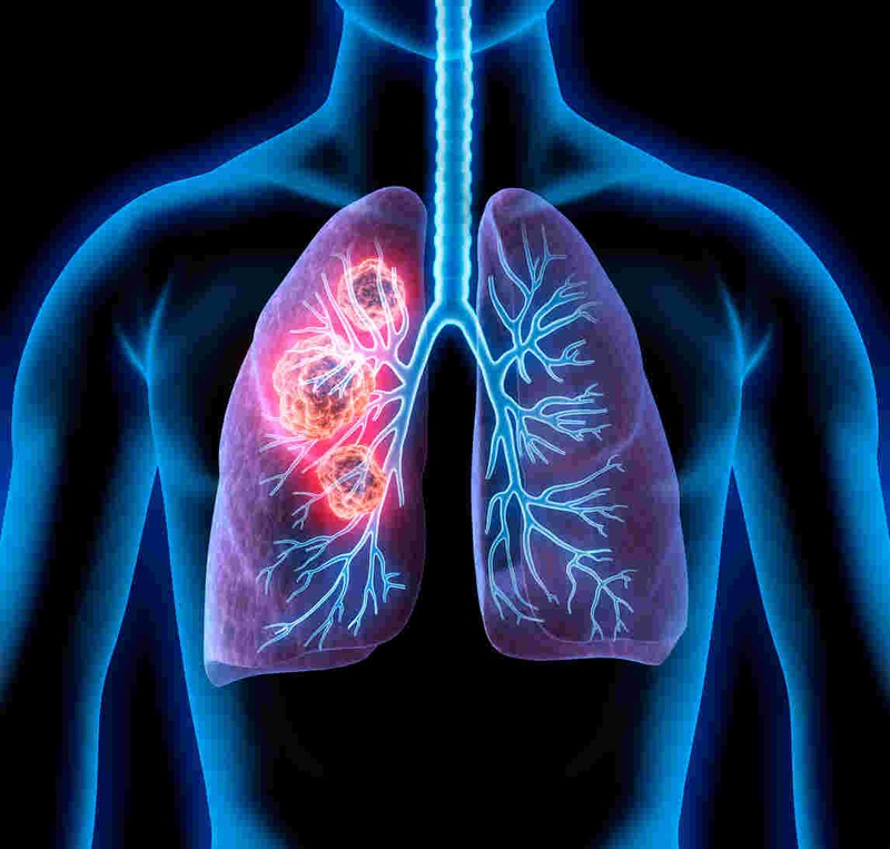 Ung thư biểu mô tế bào vảy trong phổi là bệnh gì?2