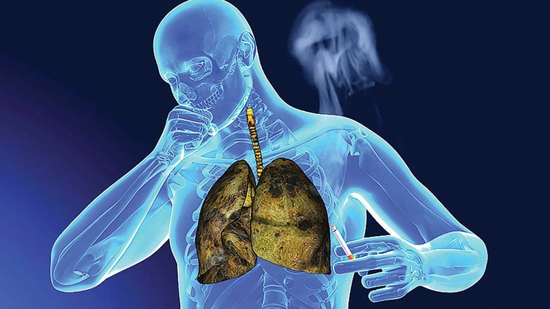 Ung thư biểu mô tế bào vảy trong phổi là bệnh gì?4