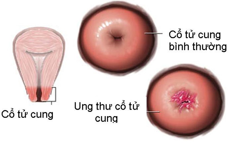 Trẻ em có bị ung thư cổ tử cung không? - Nhà thuốc FPT Long Châu