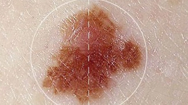 Ung thư da giai đoạn đầu có chữa được không?  2