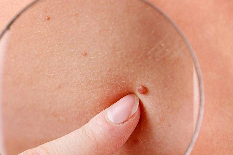 Ung thư da mặt có nguy hiểm không? 2