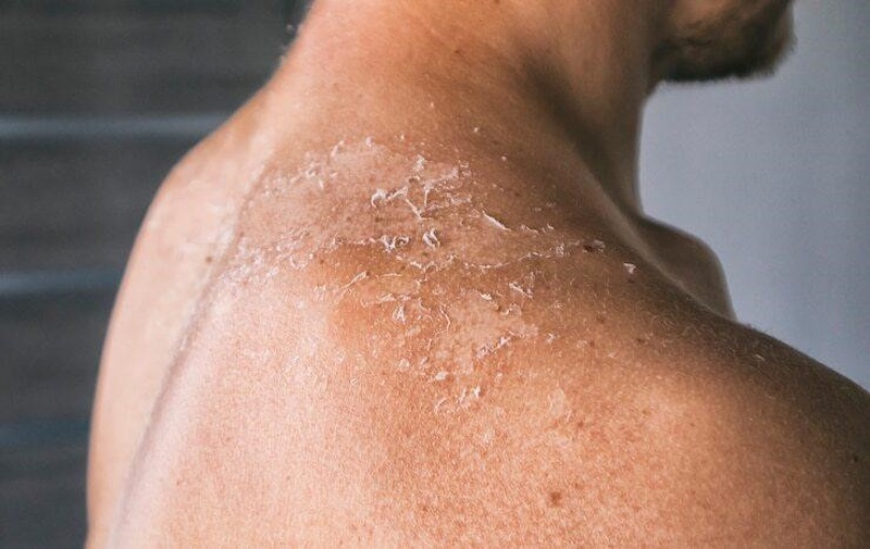 Ung thư da thường gặp ở độ tuổi nào? 3