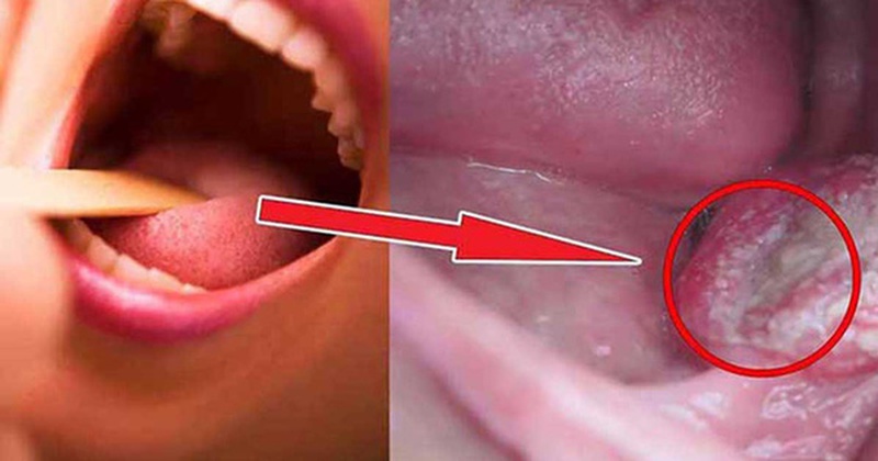 Tìm hiểu chung về ung thư xoang miệng1