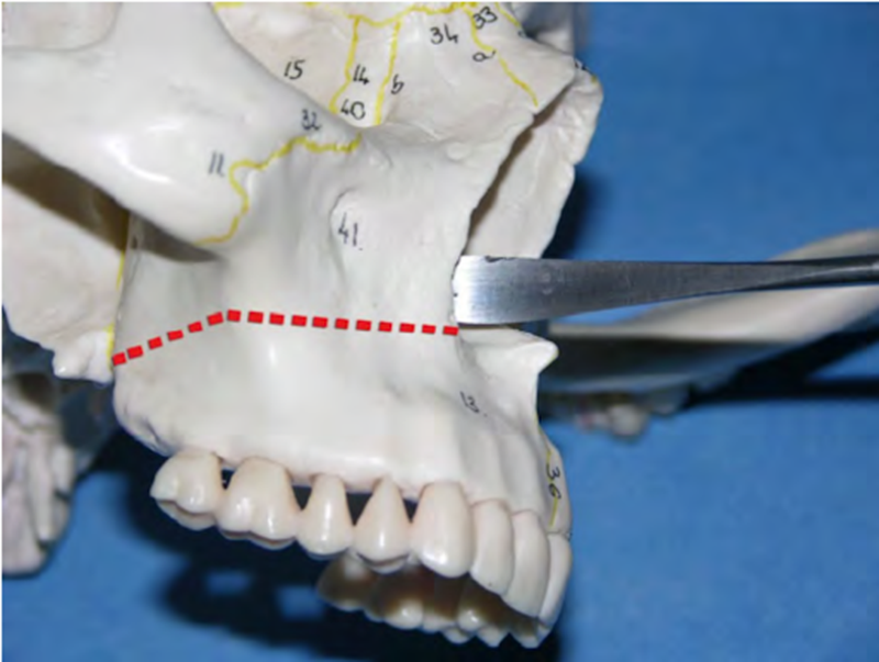 Ung thư miệng và hầu họng: Lựa chọn điều trị 2