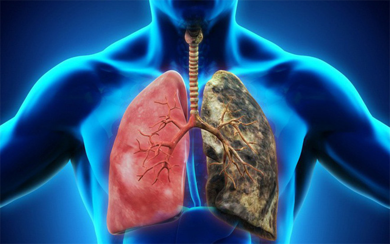 Ung thư phổi có di truyền không và tỷ lệ di truyền 1