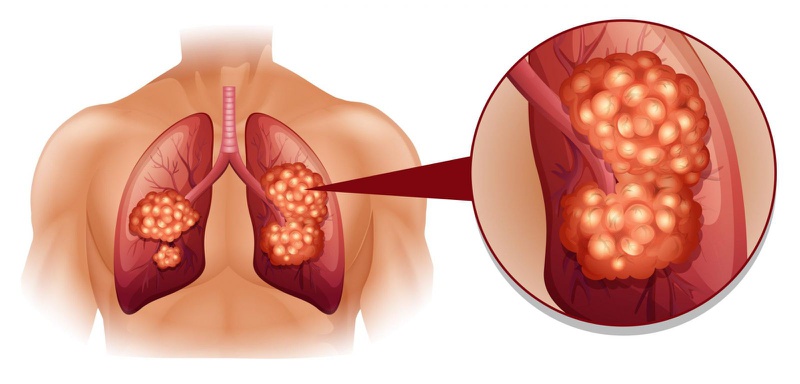 Ung thư phổi di căn có lây không?3