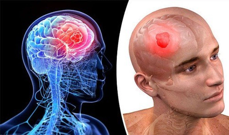 Ung thư phổi di căn não: Biểu hiện, chẩn đoán và điều trị  2
