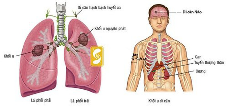 Ung thư phổi di căn não và xương có chữa được không? 3