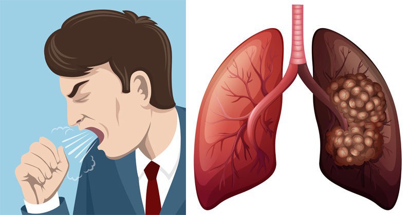 Ung thư phổi giai đoạn 2 sống được bao lâu 1