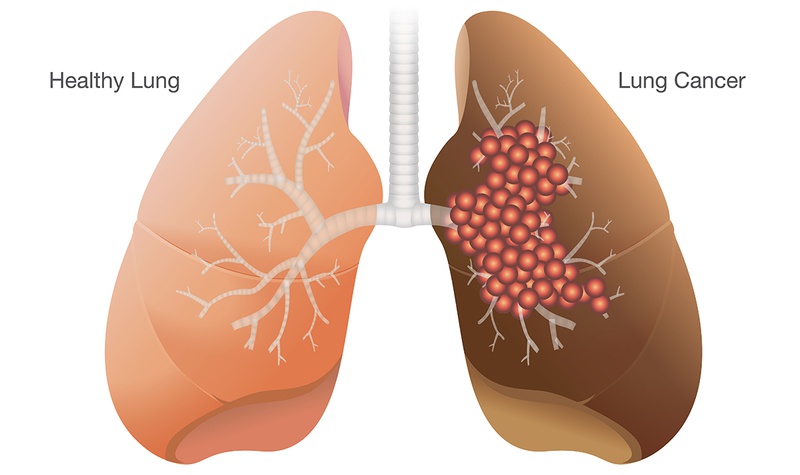 Ung thư phổi giai đoạn cuối có lây không?3