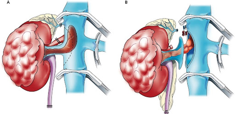 Giải đáp ung thư thận: Các loại điều trị 2