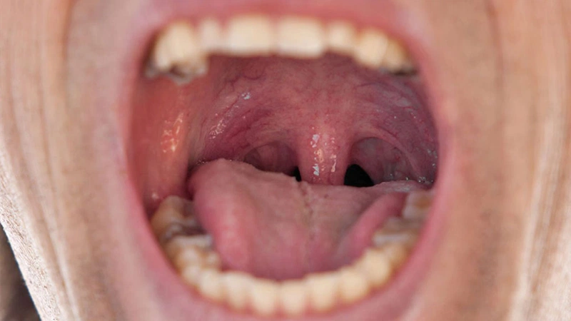 Ung thư vòm họng là gì? Những cách giúp bạn phân biệt ung thư vòm họng và viêm họng 3