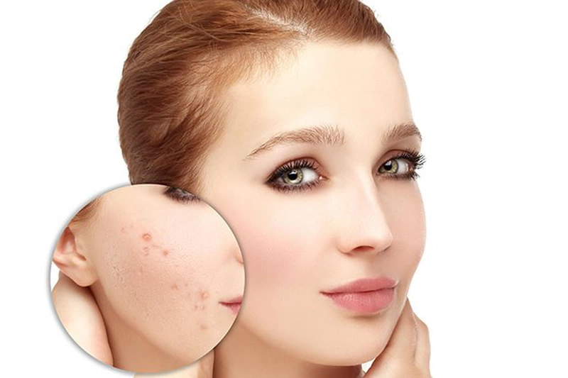 Uống collagen có bị nổi mụn không? Lưu ý khi sử dụng collagen 2
