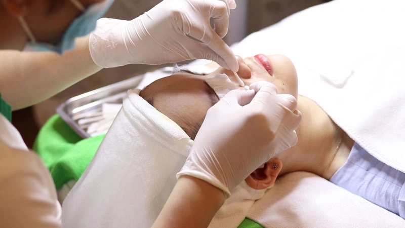 Uống Isotretinoin có nên nặn mụn không? Sự thật cần biết