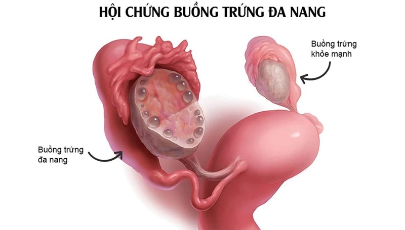 Uống thuốc tránh thai khẩn cấp có hại không? Uống thuốc đúng cách như thế nào? 3