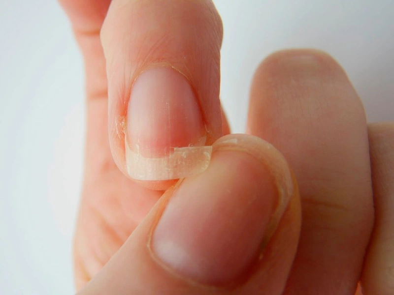 Gãy móng tay là 1 trong những dấu hiệu cơ thể thiếu kẽm