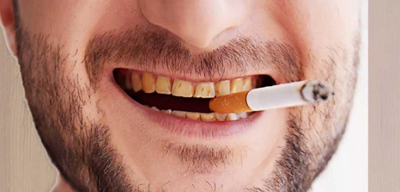 Tẩy trắng răng có an toàn với người hút thuốc không?