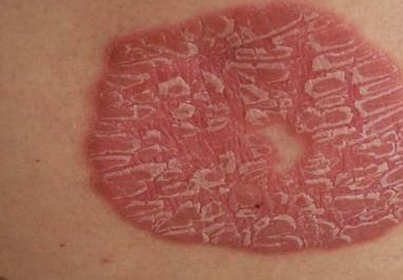 Lupus ban đỏ và vảy nến: Tổng quan và các triệu chứng 3